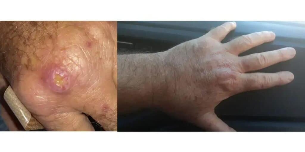 Fórum debate leishmaniose e direito ao tratamento