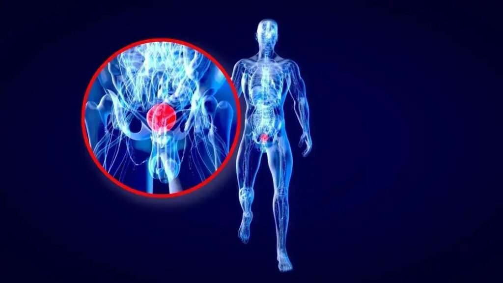 Corblindismo pode ocultar sinal de alerta para câncer de bexiga